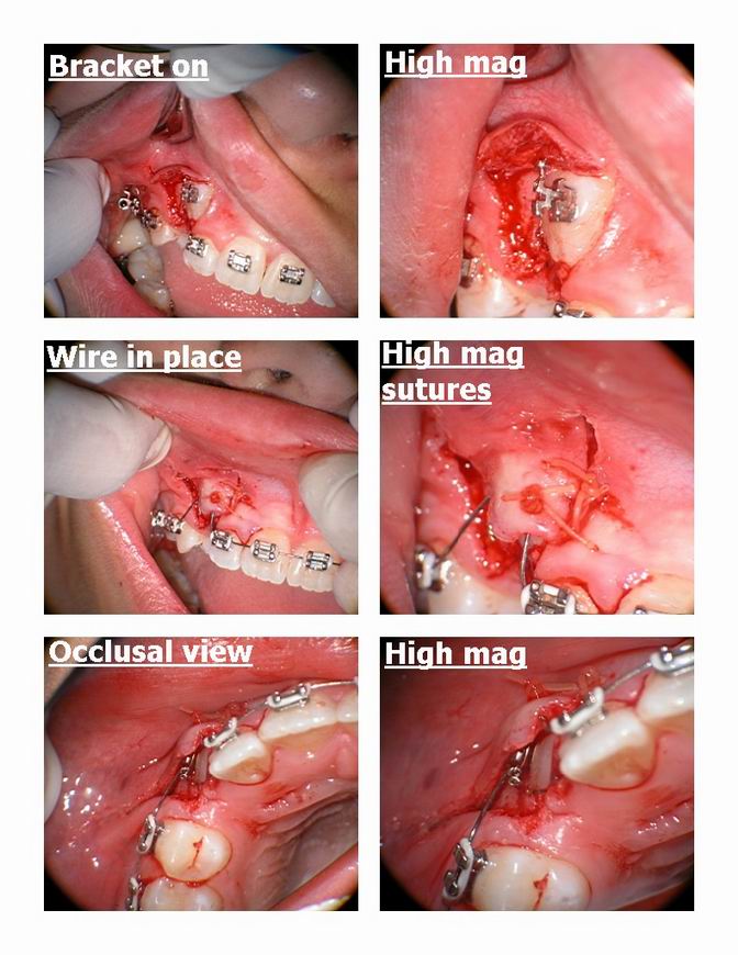 Resize of Orthodontic exposure of canine pg 2.jpg